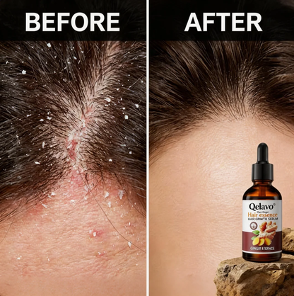 Qelavo®Ginger Anti-Hair Loss Treatment for Hair Growth